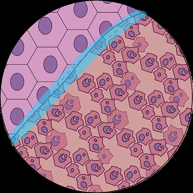 Schematic representation of the boundary between diffuse tumor cells and structured healthy cells.