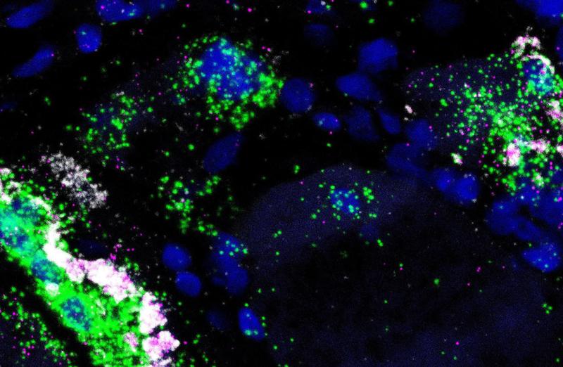 Die Fluoreszenzaufnahme (RNA in situ Hybridisierung) zeigt das vermehrte Vorhandensein der lncRNA NORAD (weiß), von ACHE (grün) und dem DNA-Schädigungsmarker GADD45A (magenta) in der entzündeten Muskulatur bei der IBM. Zellkerne sind blau dargestellt.