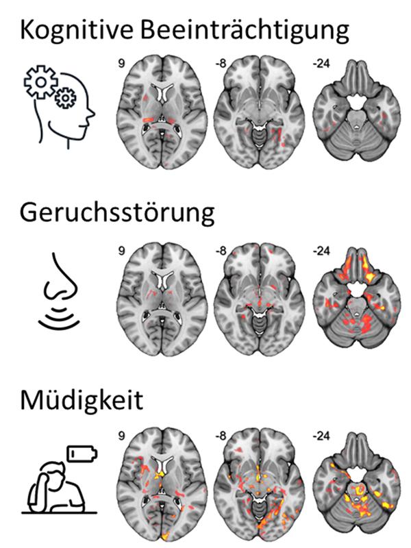 Nach einer Infektion mit COVID-19 besteht ein Zusammenhang zwischen einer veränderten Mikrostruktur in spezifischen Netzwerken des Gehirns mit kognitiven Beeinträchtigungen, Geruchsverlust und Fatigue. Je heller der Bereich, desto stärker der Zusammenhang