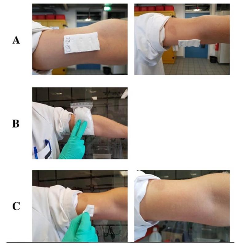 The dressing adheres reliably to the body temperature without restricting freedom of movement and can be removed painlessly by cooling.