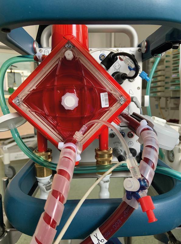 Die Extrakorporale Membranoxygenierung (ECMO) basiert auf einer pumpenunterstützten Blutumleitung, bei der über eine Membrane das Kohlendioxid entfernt und gleichzeitig das Blut mit Sauerstoff angereichert wird. 