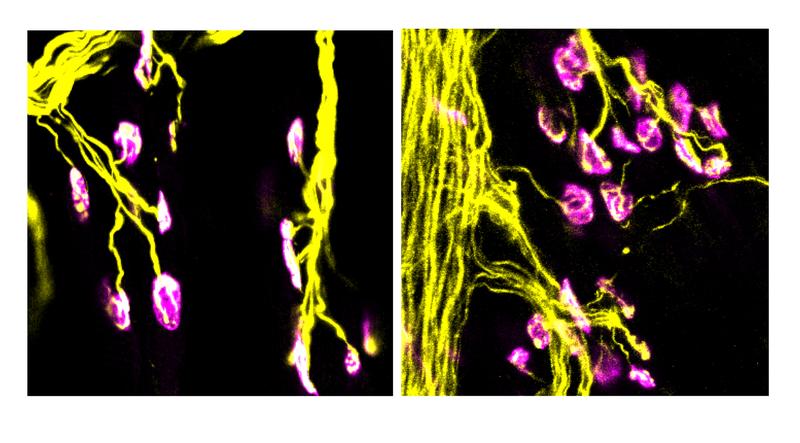 Rechts ist die Synapse zwischen Motoneuron und Zielmuskel in Mäusen mit Spinaler Muskelatrophie (SMA), links im Wildtyp. Die Nervenbahnen mit präsynaptischem Kompartiment sind gelb, das postsynaptische Kompartiment an der Muskelfaser ist magenta.