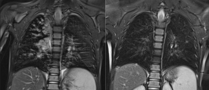 MRT-Aufnahmen eines Kindes mit Mukoviszidose: In der Lunge sind deutliche Schleimablagerungen, Erweiterungen der Bronchien und Verdickungen der Bronchialwände sichtbar (links). Rechts: Sechs Monate nach Behandlung mit der Dreifachtherapie.