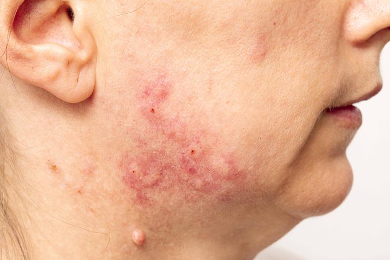 Deregulation of the sebaceous gland is a key factor in the development of acne and also plays a role in other skin conditions. (Stock photo)