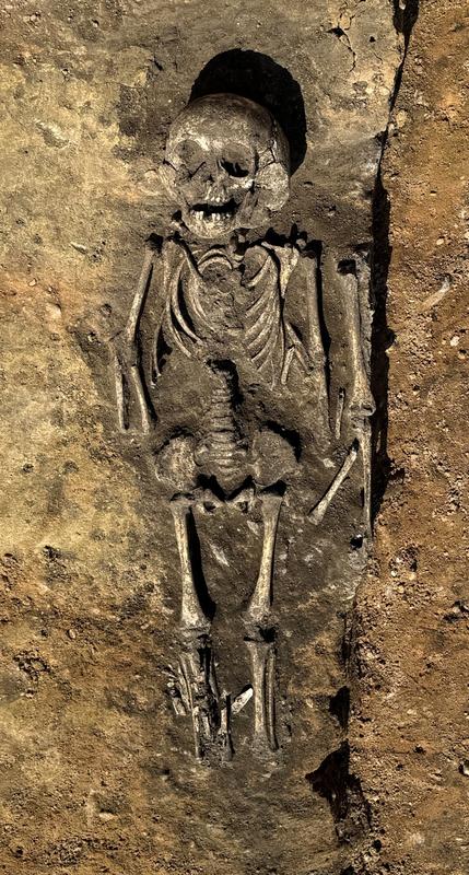 Grave of a child with 'hydrocephalus' from Wettin-Löbejün.