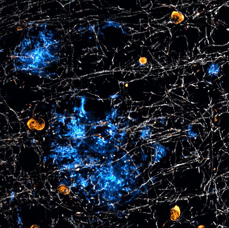 Bei Alzheimer bilden nicht nur Nervenzellen das Protein Beta-Amyloid (blau), das zu schädlichen Plaques verklumpt: Auch spezielle Gliazellen des Gehirns – die Oligodendrozyten (orange) – produzieren das Protein. Weiß gefärbt ist das isolierende Myelin.