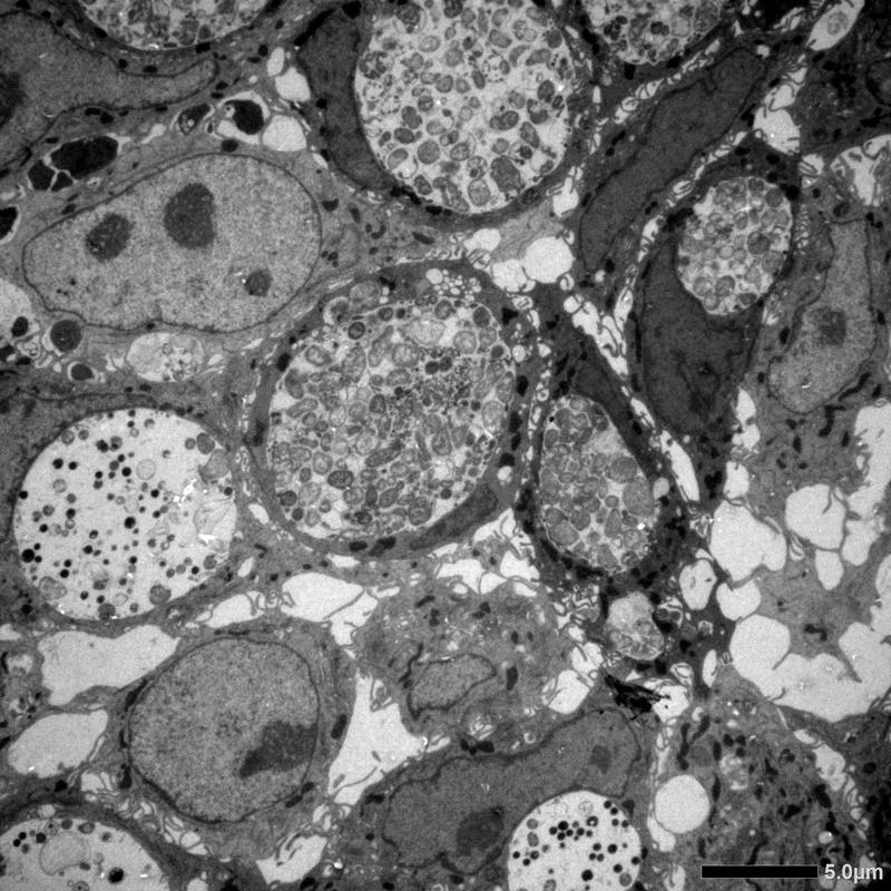 Elektronenmikroskopische Aufnahme von menschlichen Darmzellen, die mit Chlamydia trachomatis infiziert sind und morphologisch unterschiedliche Formen von Chlamydien aufweisen.