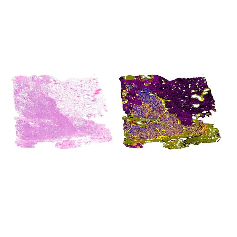 The image shows how the algorithm initially processes the typically stained tissue section (left) and creates a map in which different tissue types can be seen in different colors (blue is the tumor, in this case an adenocarcinoma of the lung)