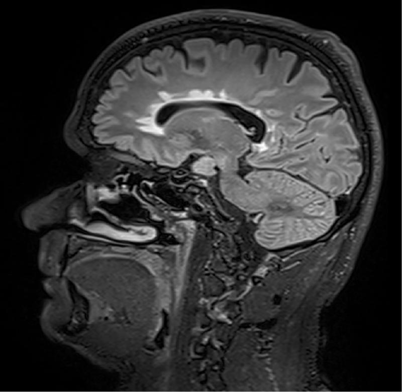 Die Aufnahmen aus der Magnetresonanztomographie zeigen mehrere entzündlichen Läsionen im Gehirn eines jungen Patienten mit Multipler Sklerose.