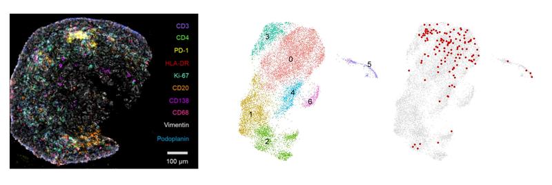 Collage mit Abbildungen aus der Originalpublikation zum krankheitsspezifischen T-Zell Rezeptormotiv, links Immunfluoreszenzanalyse, mittig und recht Einzellzell-RNA-Sequenzierung und Hochdurchsatzsequenzierung des T-Zell Rezeptors. 