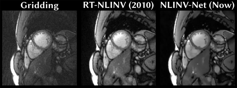 Short-axis section through the heart: The simple MRI image reconstruction method “Gridding” (left), “RT-NLINV” method developed in 2010 (center) and the new “NLINV-Net” method (right), combining the modeling of RT-NLINV with machine learning.