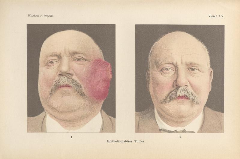 Das Werk "Radiumtherapie" enthält zahlreiche Abbildungen und Bildtafeln, die den Krankheitsverlauf dokumentieren.