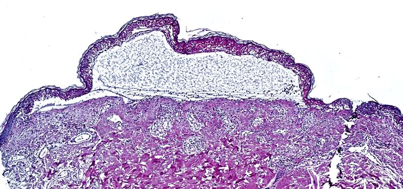 Aufnahme einer toxischen epidermalen Nekrolyse, die eine Ablösung der Epidermis zeigt.