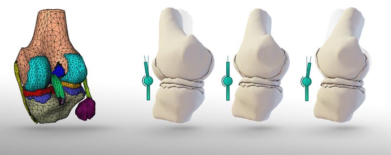 A finite element simulation model of the knee joint (left) enables the dynamic prediction and analysis of various joint positions, such as hyperextension, resting position, and 20° flexion, from left to right (MRI data University Medical Center Freiburg).