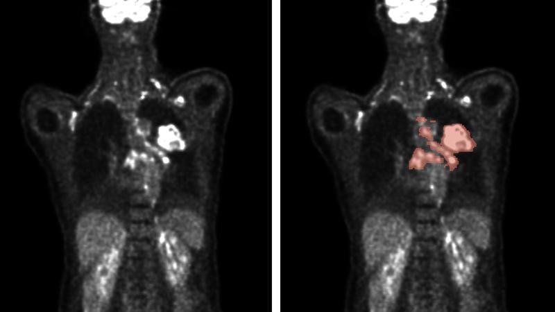 Automatische Verfahren ermöglichen die Analyse von PET/CT-Scans (links) zur präzisen Vorhersage von Tumorlage und -größe (rechts). 