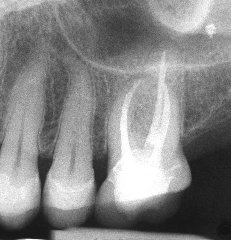 Wurzelfüllung eines oberen Backenzahns auf dem Röntgenbild