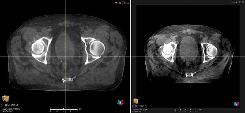 Querschnitt im Bereich des Beckens – Mit der neuen KI-gestützte Bildgebungslösung Iris (Bild links) erhält man eine deutlich verbesserte Bildqualität als mit dem herkömmlichen CBCT (Bild rechts).