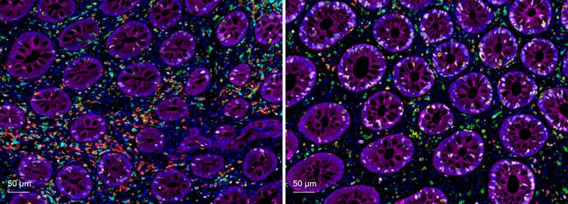 Darmgewebe eines Patienten vor (links) und nach Extrakorporaler Photopherese (rechts). Verschiedene Immunzellen sind grün, hellblau, rot, gelb, rosa und pink markiert. Nach der Behandlung sind deutlich weniger Entzündungsboten vorhanden. 