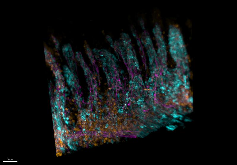 Activated donor T-cells migrate into intestinal tissue, triggering aGvHD. The 3D microscopy image shows how donor T-cells (blue) interact with the body's immune cells, macrophages (gold), in the small intestine (ileum). Blood vessels are shown in magenta.