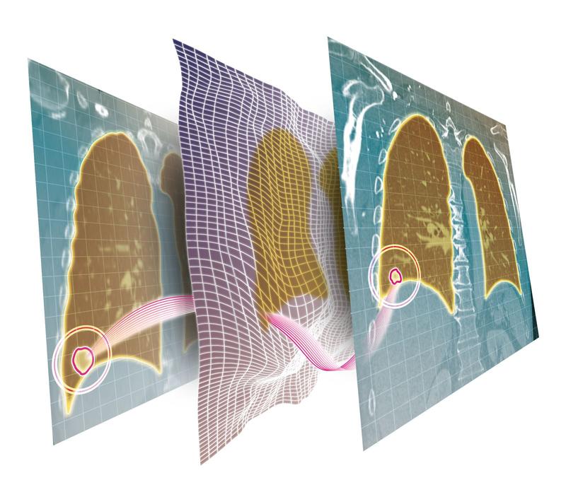 Dank eines Deep-Learning-Ansatzes lassen sich CT-Bilder in der Krebstherapie automatisch abgleichen.