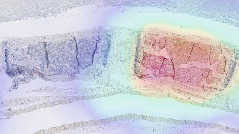 In der rechten Hälfte dieses Gewebeschnitts attackieren modifizierte Immunzellen, sogenannte CAR-T-Zellen, Tumorgewebe. Mit einem neuen Verfahren können sie durch PET-Bildgebung im Körper durch sichtbar gemacht werden (hier nachträglich überlagert). 