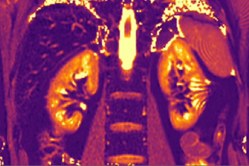 Karte der T1 Relaxationszeiten der Niere, die im Rahmen der mpMRT erhoben wird. Dieser quantitative Parameter kann Aufschluss über die Gewebezusammensetzung der Niere geben und somit gesundes von pathologischem Nierengewebe unterscheiden.