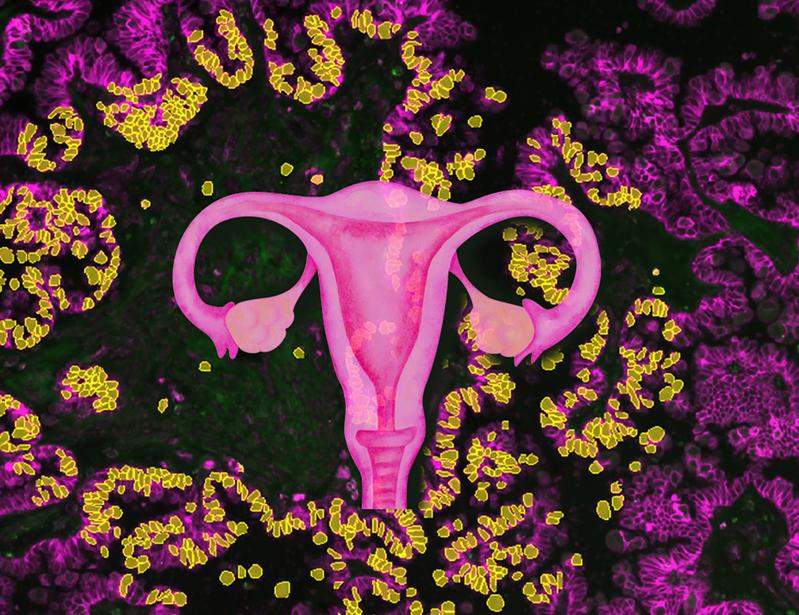 Gewebeschnitt eines serösen Borderline Tumors. In diesem mikroskopischen Bild sind die Zellen mittels Immuno-Fluoreszenz gefärbt. Einzelne Zellen des Tumors können mittels künstlicher Intelligenz erkannt werden (gelb).
