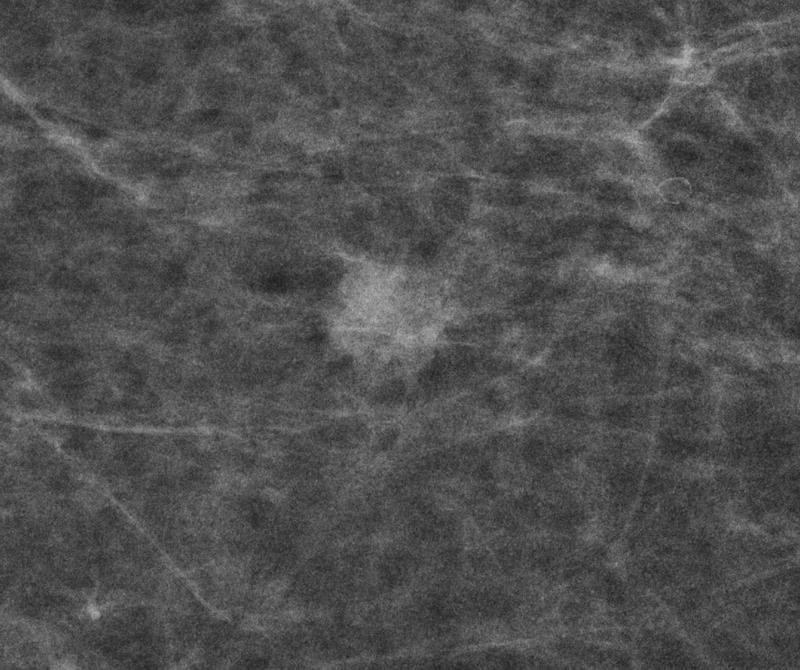 Screening-detektiertes Mammakarzinom, dargestellt durch einen unscharf begrenzten Herd; Histologie: Mammakarzinom nicht spezieller Typ, Grad 2. 