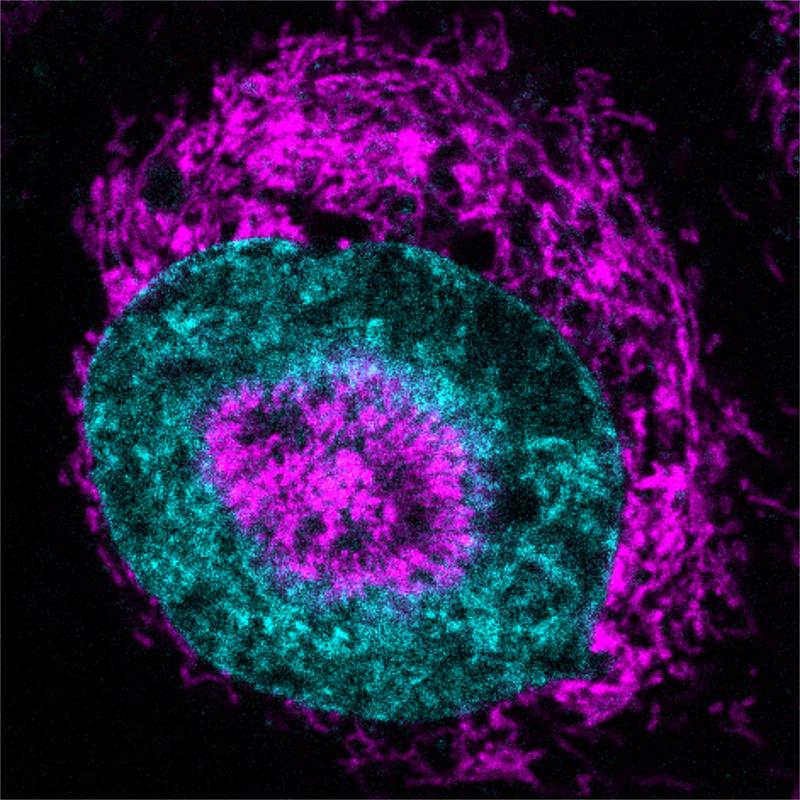Das Innere einer gequetschten Krebszelle, in der sich die Mitochondrien (pink) außen am Zellkern (cyan) und in „Vertiefungen” des Zellkerns ansammeln.