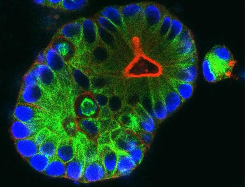 Mini-Tumore, sogenannte Organoide, werden aus Gewebe von Enddarmkrebs hergestellt. Sie dienen als Modell des Tumors, um neue Therapien zu testen. 