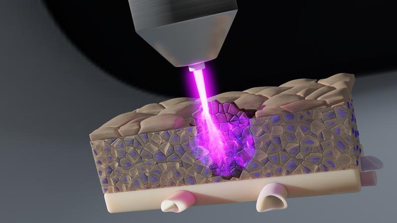 Reaktive Sauerstoffmoleküle, die durch die Plasmatherapie gebildet werden, können tief ins Gewebe eindringen. So können Tumorzellen auch in tieferen Gewebeschichten erreicht und abgetötet werden. 