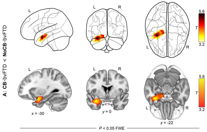 Persons exhibiting criminal behavior showed larger atrophy in the temporal lobe