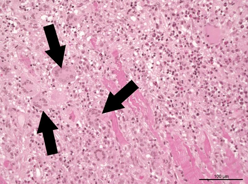 The microscope image of a tissue sample from a diseased heart muscle shows giant cells, which give giant cell myocarditis its name. 