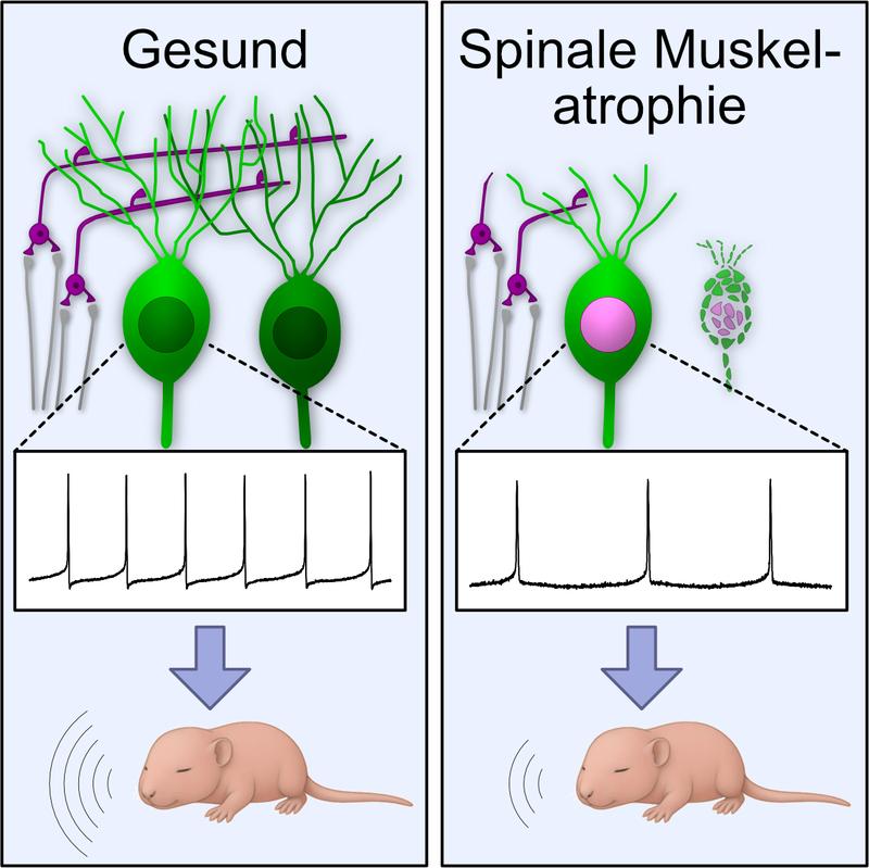 Bei schwerer spinaler Muskelatrophie verlieren die Nervenzellen im Kleinhirn wichtige Verbindungen: Synapsen der Körnerzellen (magenta) gehen zugrunde, und Purkinje-Zellen (grün) sterben ab.