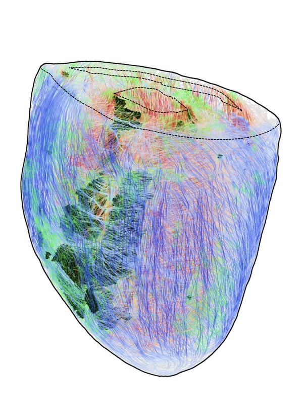 3D-Rekonstruktion eines Herzens: Die Muskelzellen sind faserartig angeordnet (bunte Markierungen). Die Forschenden können dadurch erkennen, wie Narbengewebe (grau) die elektrische Erregungsausbreitung stört.