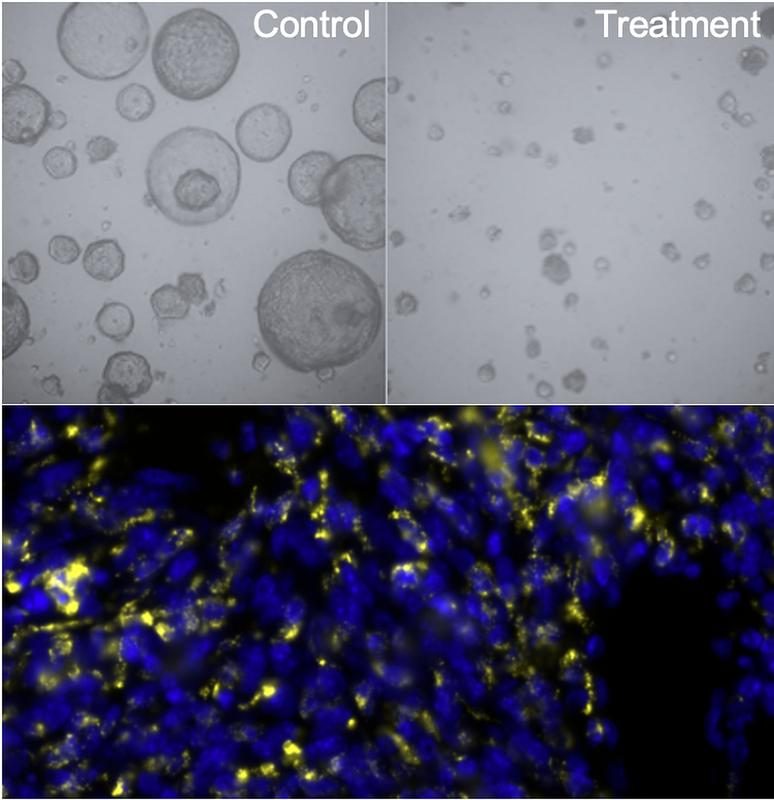 Oben: Mini-Tumormodelle aus Patient*innengewebe, sogenannte Organoide, ohne und mit Behandlung. Unten: Tumor (blau) mit Makrophagen (gelb) Fresszellen, die bösartig veränderte Zellen erkennen und beseitigen können.
