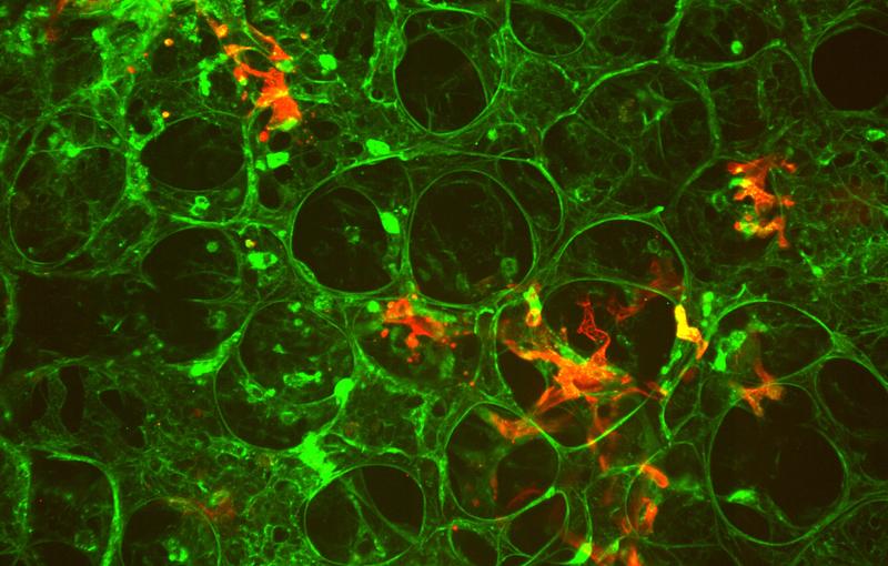 Tumor cell in the maze of the lung vasculature of a mouse.  