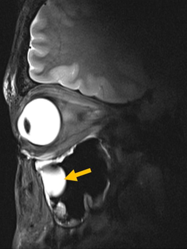 High-resolution 7.0 T MRI of the eye and orbit of a volunteer that shows in great detail the anterior cranial structures, including the extraocular muscles, optic nerve, and a cyst adjacent (yellow arrow) to the left orbit.
