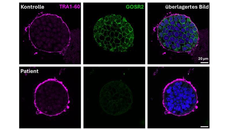 Induced pluripotent stem cells from a healthy subject (top row). Stem cells from a GOSR2 patient with greatly reduced expression are shown in the bottom row.