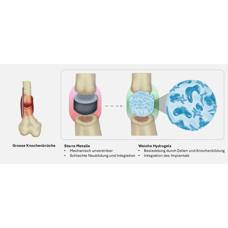 Um Knochen zu verbinden, werden heute harte steife Implantate verwendet (l.). Künftig könnten weiche Implantate aus einem Hydrogel eingesetzt werden. 
