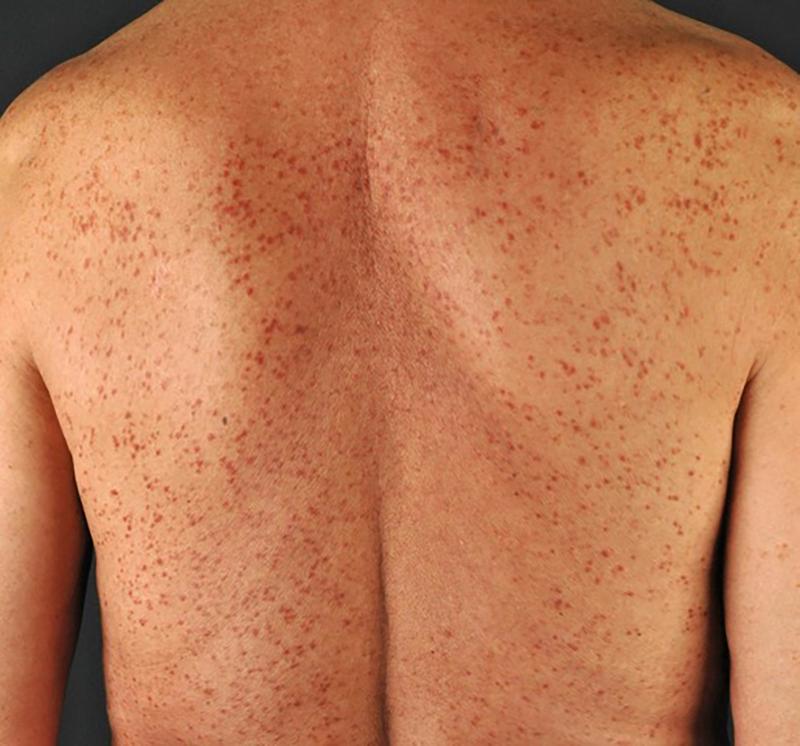 Typische Hautläsionen bei Mastozytose. Eine Basler Studie zeigt: Mit KI lässt sich sich der Erfolg der Behandlung präzise quantifizieren.