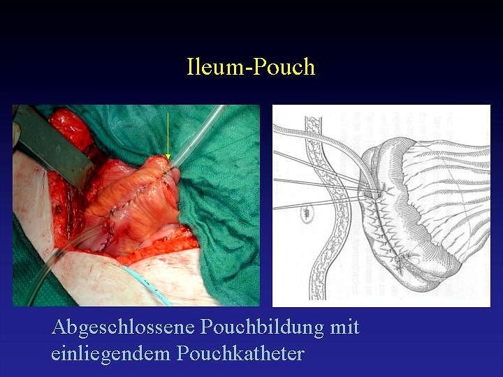 Die fertige Ersatzblase, die an der Bauchwand befestigt wird und über einen Katheter von außen geleert werden kann (rechts in schematischer Darstellung)