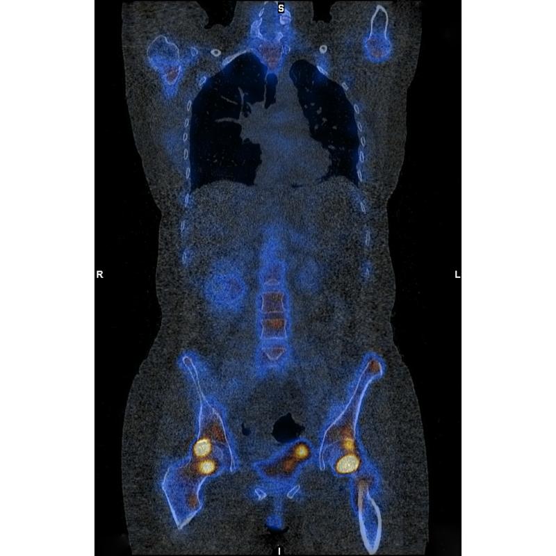 Skelettszintigraphie einer betroffenen Patientin mit Osteomalazie in den Hüften (gelb) nach intravenöser Eisentherapie mit Eisencarboxymaltose. 