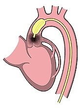 Ist die Aortenklappe des Herzens geschlossen, wird der Ballon des neuen Katheters mit Helium aufgeblasen. Gleichzeitig fließt injiziertes Kontrastmittel in die Kranzgefäße. Bei geöffneter Klappe strömt das Blut weitgehend ungehindert am Ballon vorbei