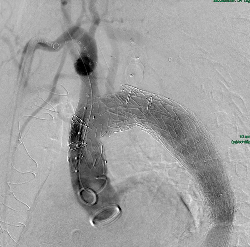Die intraoperative Abschlussangiografie zeigt die erfolgreiche Implantation der dreifach gebranchten Aortenbogenprothese.