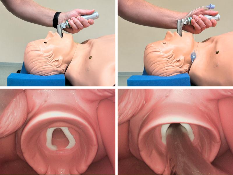 Laryngoskopie und Intubation im Trainingslabor. Oben links Laryngoskopie mit konventionellem Laryngoskop, rechts Einführung des Tubus. Unten links ideale Sicht auf Stimmbandebene, rechts korrekte Platzierung in der Trachea zwischen den Stimmbändern. p