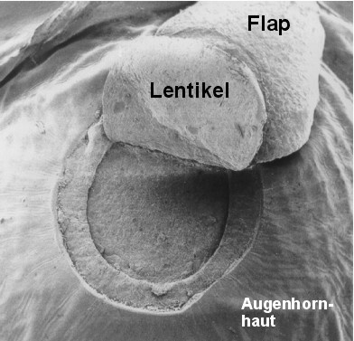 Präzise Cornea-Bearbeitung mittels Femtosekunden-Laser zur Fehlsichtigkeitskorrektur (LASIK-Verfahren), Quelle: Laser Zentrum Hannover