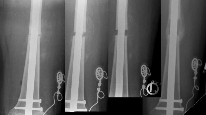 Röntgenaufnahme des Implantats im Knochen