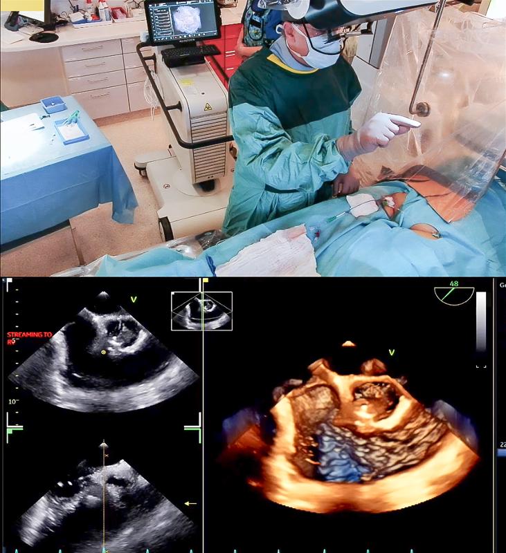 Diagnosesicherheit ist Patientensicherheit. Professor Schubert betrachtet die Größe der Herzkammern und die Herzfunktion am Hologramm (s. oben) zusätzlich zur hochmodernen Bildgebung durch die transösophageale Echokardiografie (Bild unten)