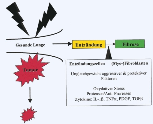 Auf dem Weg zum Tumor wird bei der Strahlentherapie auch gesundes Lungengewebe getroffen. Die potenziellen Nebenwirkungen - Entzündung und Fibrose - stehen im Mittelpunkt eines von der Deutschen Krebshilfe geförderten Forschungsprojekts. Grafik: Kolb